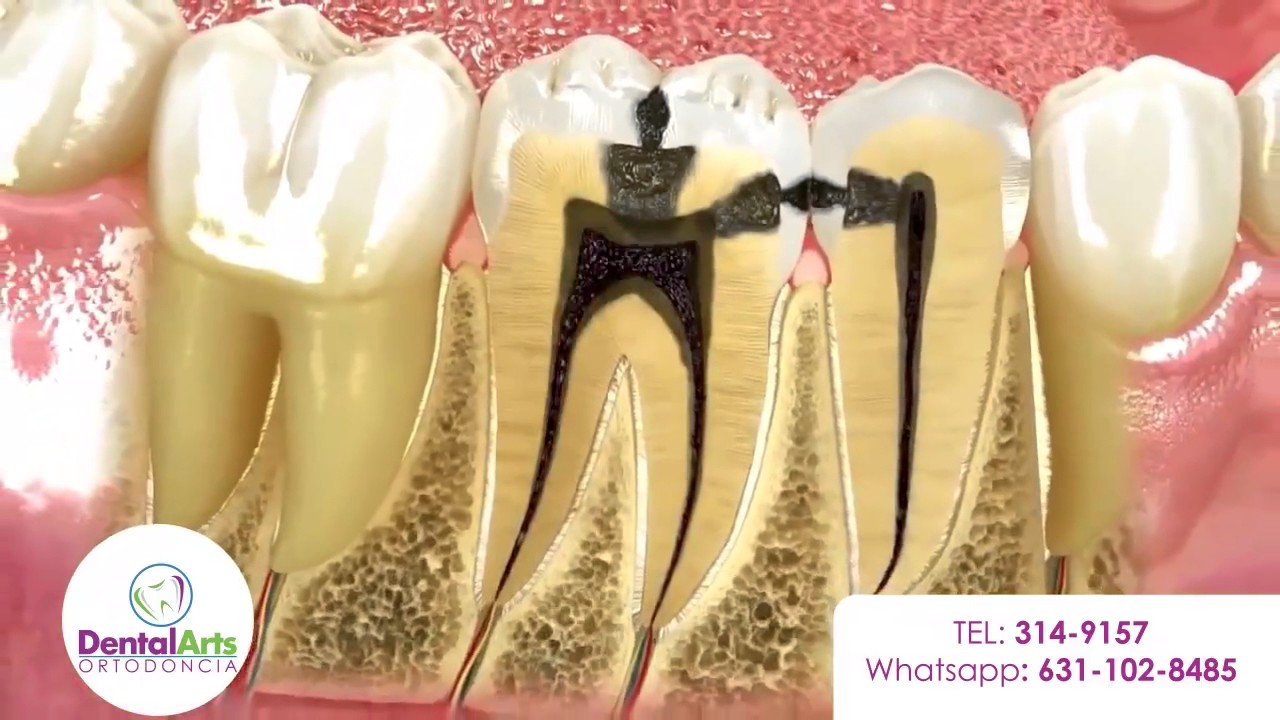 Dental Arts Nogales Mall Las Caries YouTube