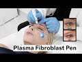 Plasma Fibroblast Pen to Treat Crepey Eyelids