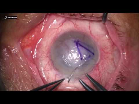 Omnigen 'patch' and contact lens applicaton for epithelial defect - '3 minute surgery' - video from Nu Vision