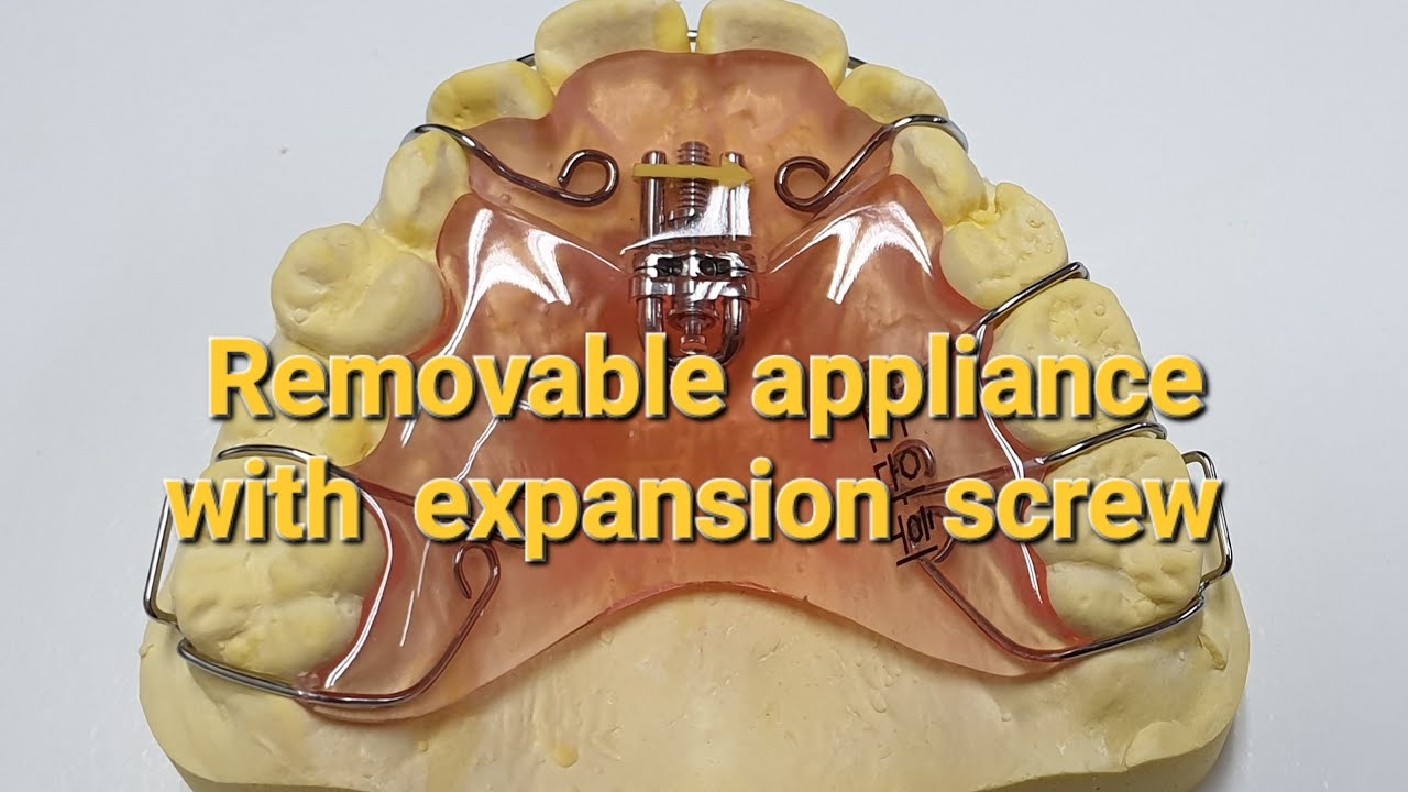 Expansion screw/ Removable appliances with expansion screw/악궁확장장치 YouTube