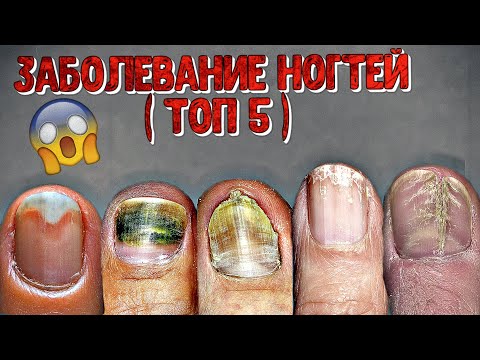 топ 5 заболеваний на ногтях