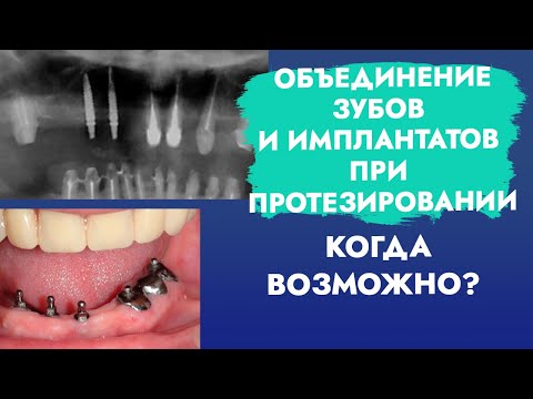 Объединение зубов и имплантатов при протезировании. Когда возможно?