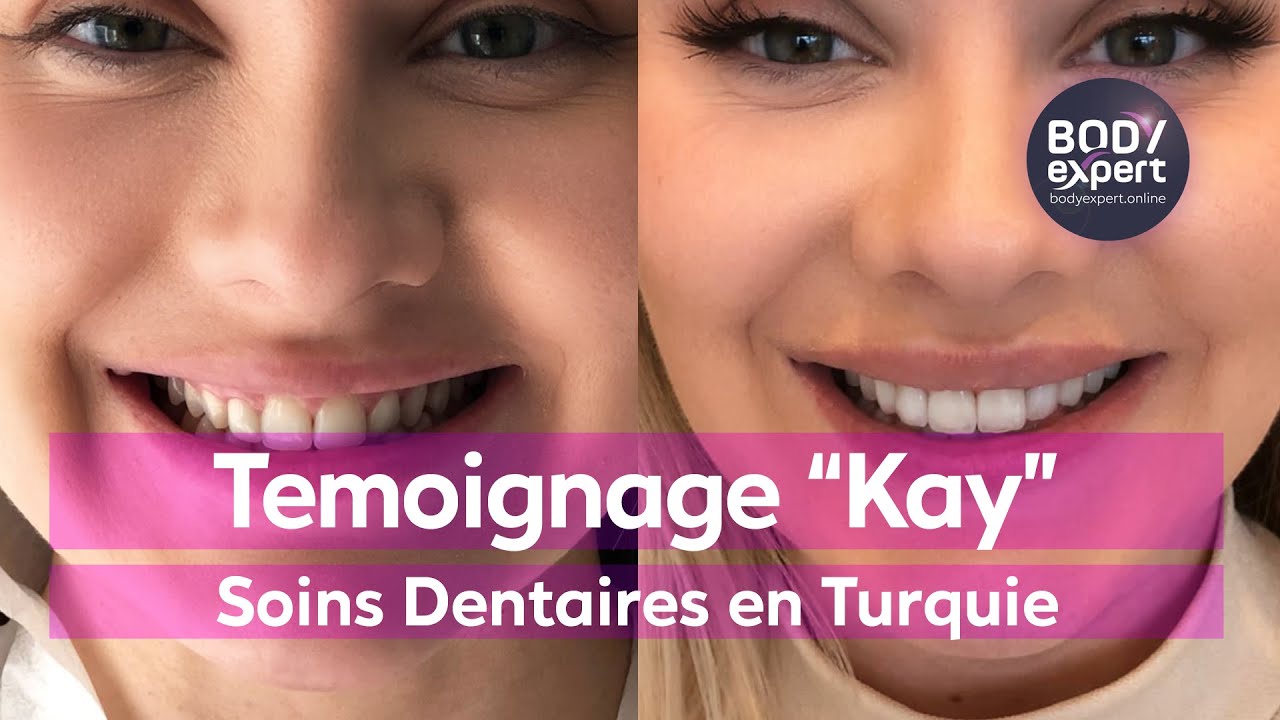 Facette Sans Limer Les Dents Turquie