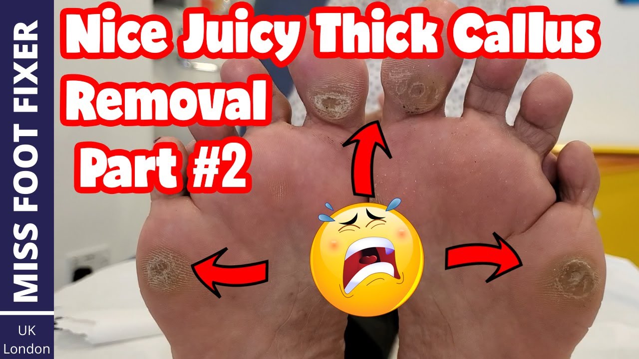 SATISFYING THICKEST AND GIANT CALLUSES REMOVAL BY MISS FOOT FIXER 