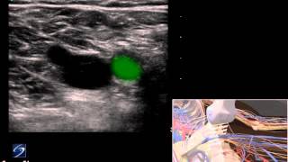 3D How To: Deep Vein Thrombosis Ultrasound Exam - SonoSite Ultrasound