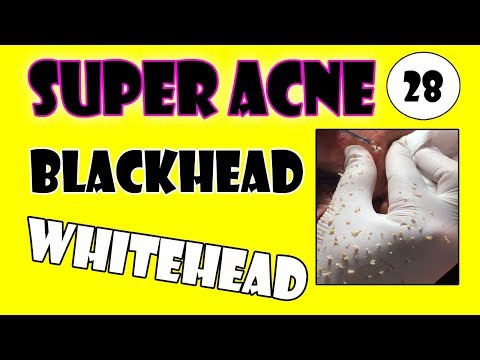 Cystic Acne Treatment Jully  - Top Super Acne Pop Up Instantly Blackheads & Whiteheads