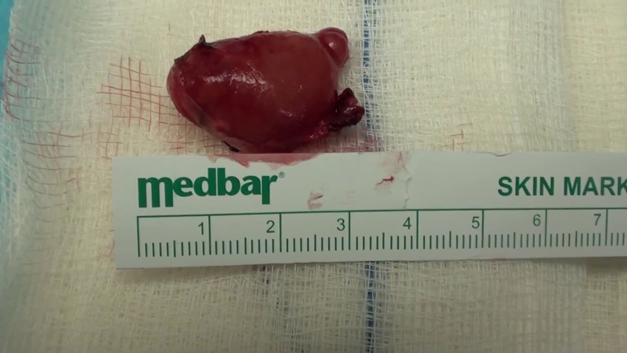 Биопсия шейного лимфоузла