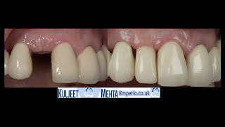 Socket Shield Technique with MINI Implant by Dr Kuljeet Singh Mehta-Periodontist 1,564 views 2 years ago 11 minutes, 16 seconds