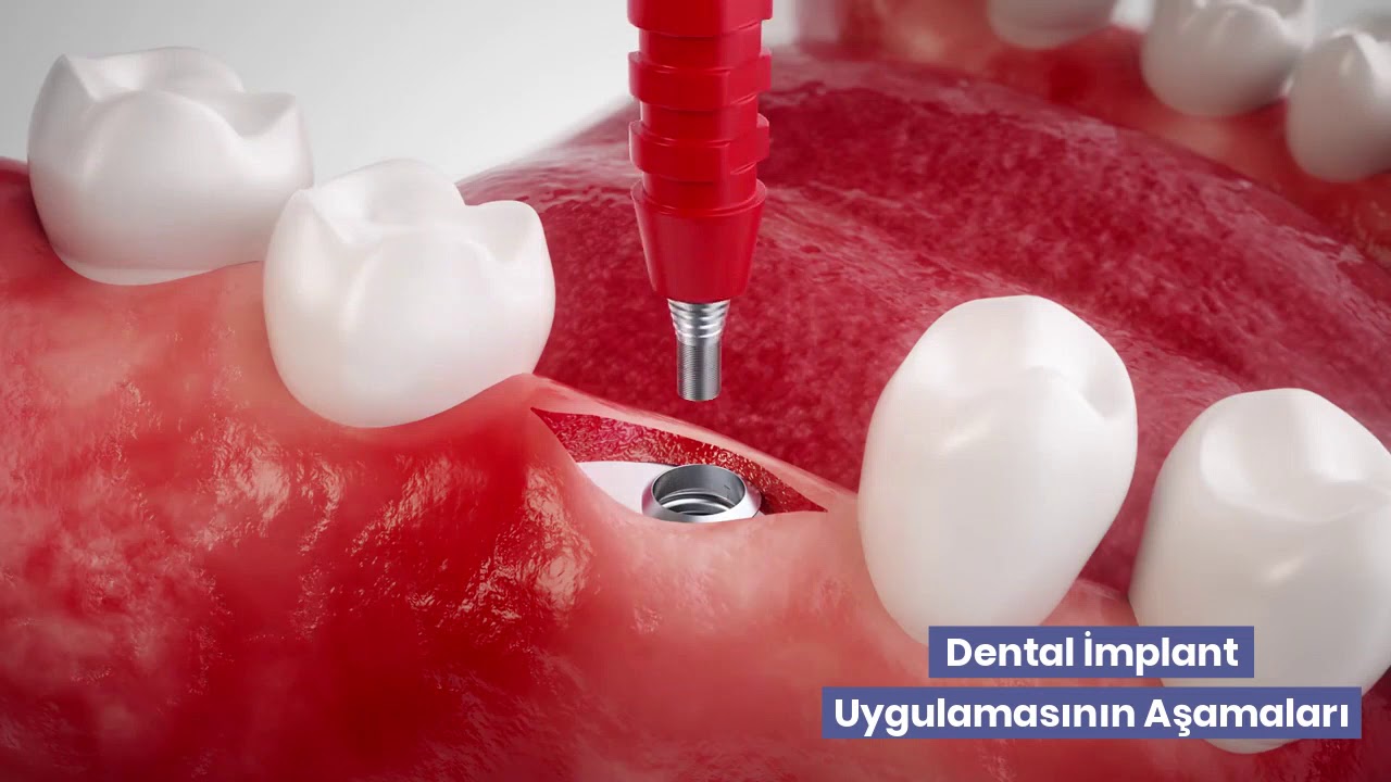 Dental İmplantın Aşamaları Nelerdir?