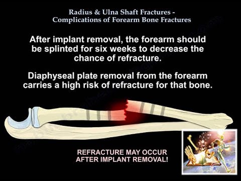 Video: Ulna - Structure, Fracture, After Fracture