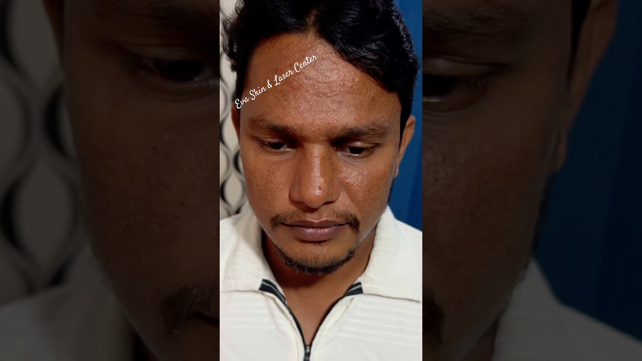 Acne treatment journey 