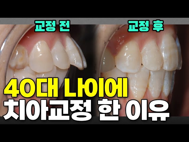 중년치아교정, 나이의 문제가 아닙니다
