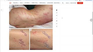 How to Biopsy Larva Currens