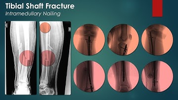 Tibial Shaft Fracture: Intramedullary Nailing