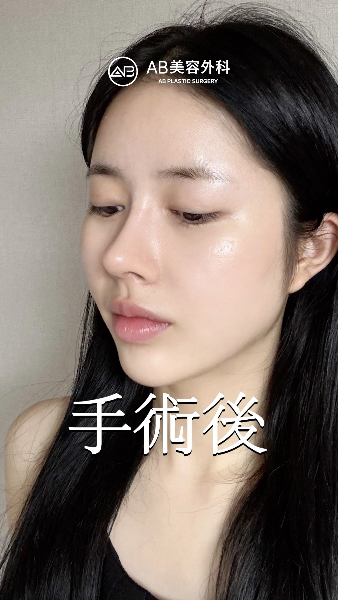 鼻整形で人生変わった美人。 #shorts