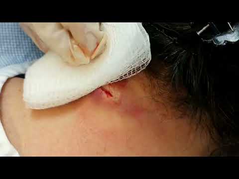 Drainage of Infected Epidermal Cyst