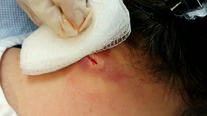 Drainage of Infected Epidermal Cyst