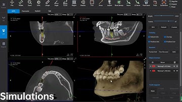 Dental Cone Beam CT software Single function display -- LargeV SmartVPro--Implant Simulation