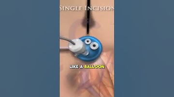 Colorectal cancer laparoscopic surgery   3d animat