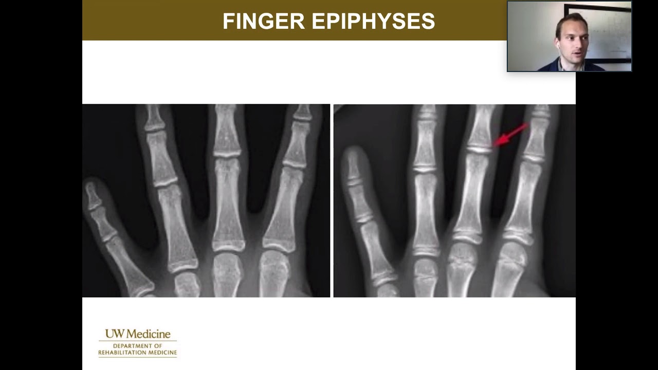 Youth Rock Climbing Injury Reduction Strategies