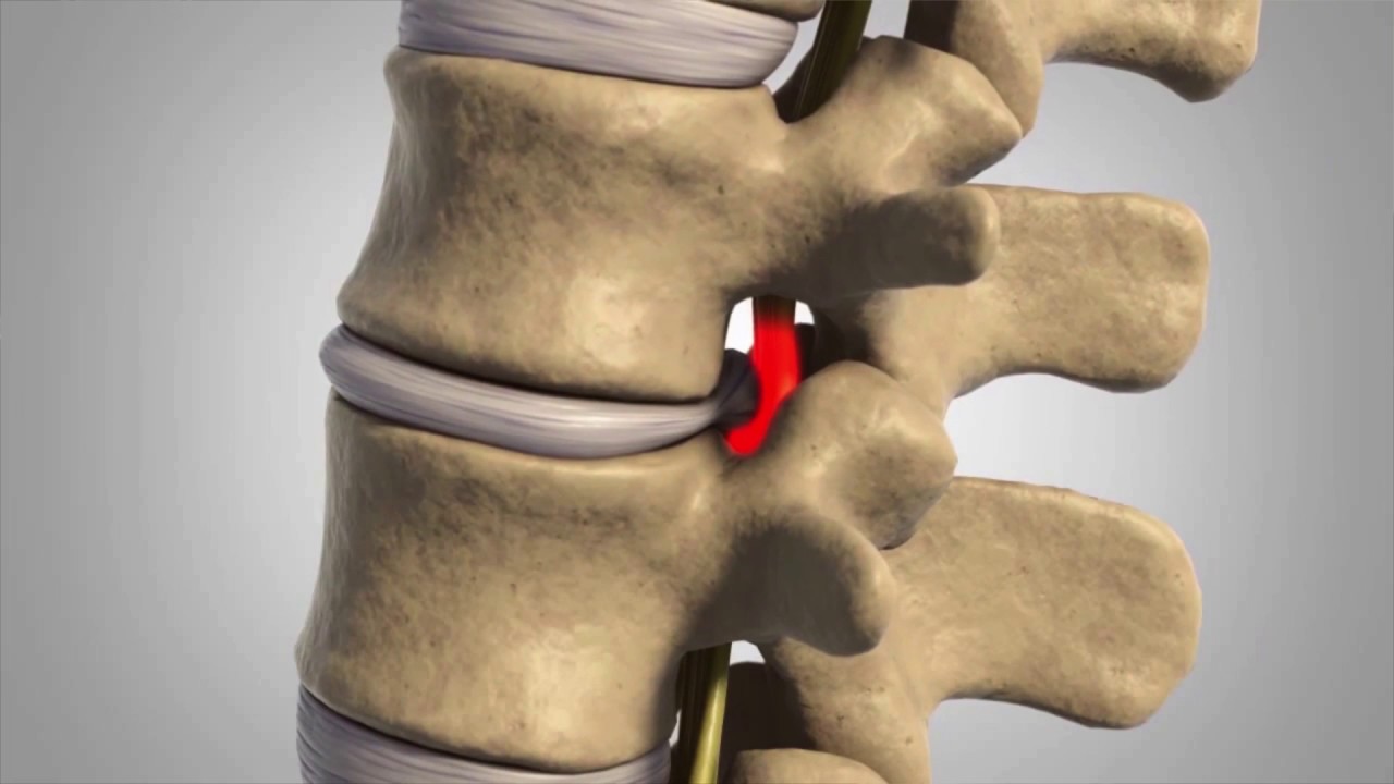 Pure Chiropractic Center Spinal Decompression