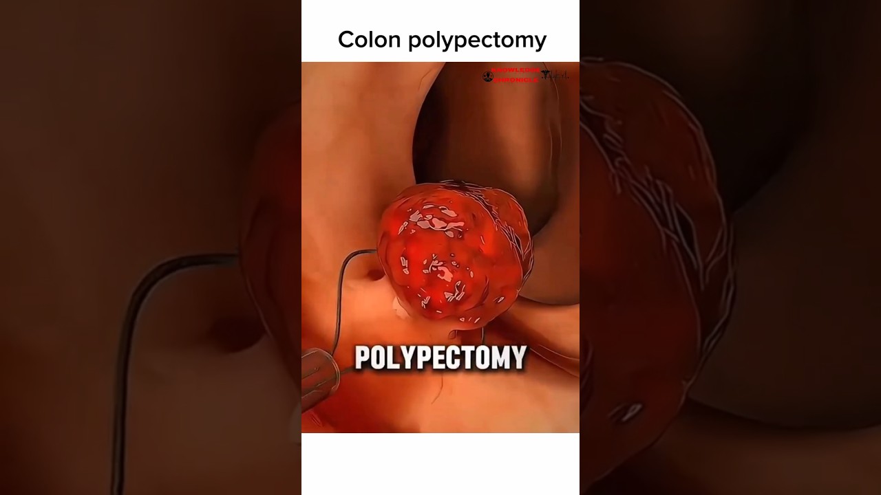Процедура полипэктомии толстой кишки: как безопасно удалять полипы 