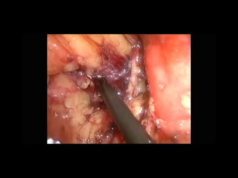 Endoscopically Assisted Extralevator Abdominoperineal Excision