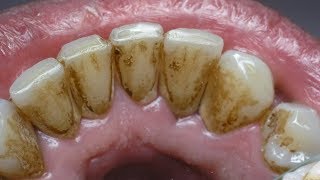طريقة فعالة في إزالة الرواسب البكتيرية من باطن الأسنان.. شاركها جزاك الله خيرا !