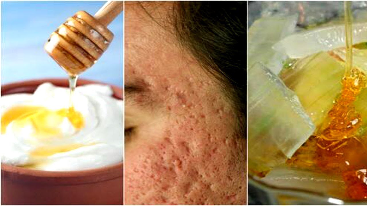 Is Acne Leaving Marks on Your Face Learn About 5 Face Masks for Pock