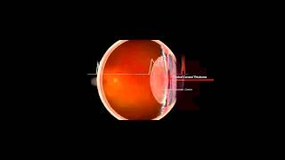 LENSTAR Training - Pachymetry