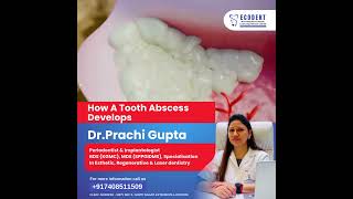 How a Tooth Abscess Develops | Symptoms & Treatment Explained 🦷💢