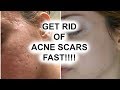 HOW TO GET RID OF ACNE SCARS  || Pershii