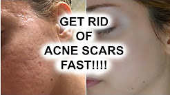 HOW TO GET RID OF ACNE SCARS  || Pershii