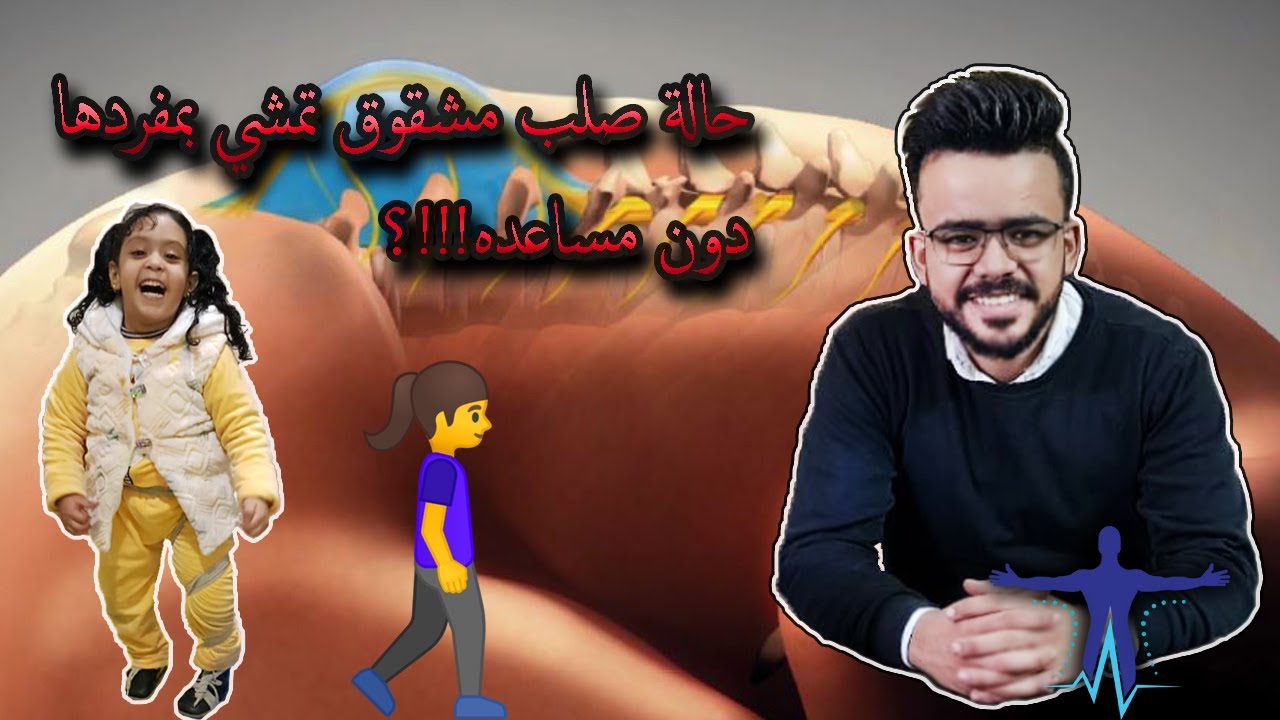 ?!!الصلب المشقوق انواعه احتمالية حدوثه وهل يمكن العلاج منه |Spina bifida