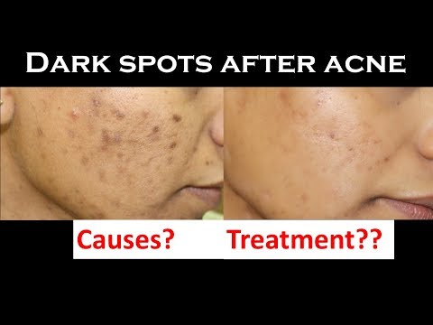 Dark spot after acne| post inflammatory hyperpigmentation |  causes & treatment | dermatologist
