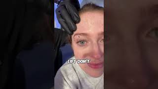 Never inject here to correct brow ptosis!