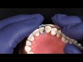 NEW Fusion Anterior Matrix System from Garrison Dental Solutions