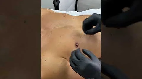 Quando si ritira il capezzolo?
