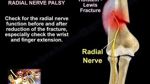 Fracture Humerus & Radial Nerve Palsy - Everything You Need To Know - Dr. Nabil Ebraheim