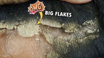 Scratching Dry Itchy Scalp Dandruff Removal #575