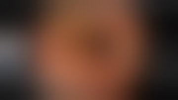 Endoscopic procedure of Ulceratic Colitis