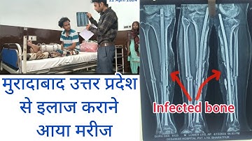 Tibia fibula geïnfecteerde botfractuur Niet-geconsolideerde behandeling in Deshwar Hospital Bhara...