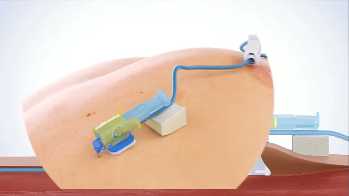 PPS CT Huber Needle – One-handed safety needle activation