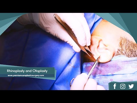 rhinoplasty-and-otoplasty