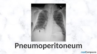 Pneumoperitoneum Chest X-Ray Signs | High Yield | Radiology