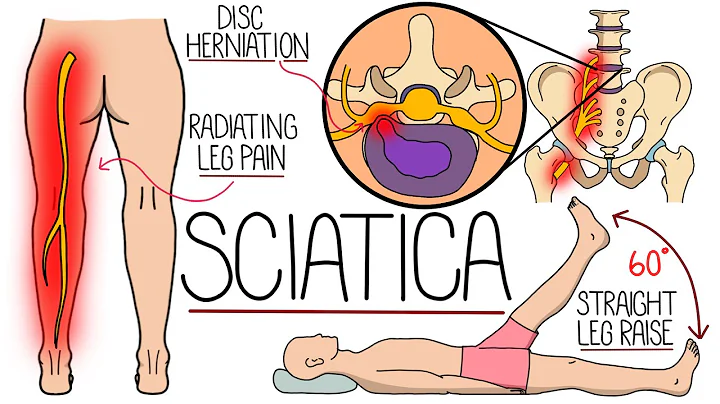 Sciatica Explained (Including Red Flag Symptoms)
