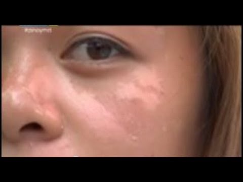 Video: Paano Magagamot ang isang Sunburn (na may Mga Larawan)