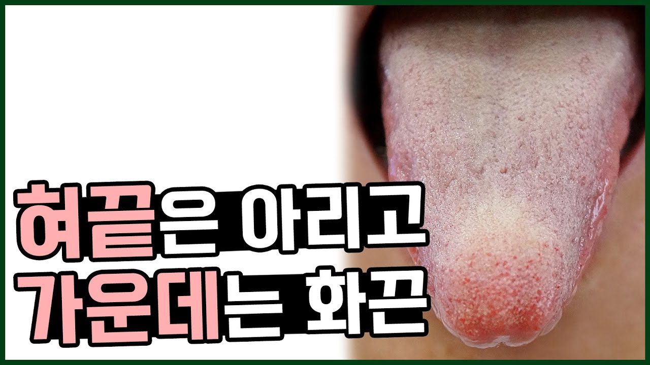 혀끝은 아리고 쐬하고 혀 가운데는 화끈거려요 - YouTube