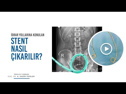 İDRAR YOLLARINA KONULAN STENTİN ÇIKARILMASI