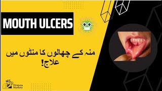 Mouth ulcer home remedy | Mouth ulcer causes | Somogel cream.